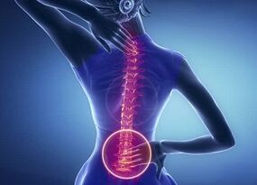 manifestaciones de osteocondrosis lumbar